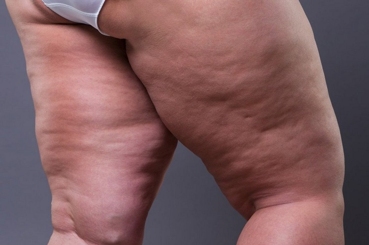 Leg Fat Vs. Cellulite